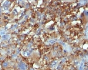 Formalin-fixed, paraffin-embedded human Histiocytoma stained with CD68 antibody.