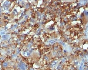 Formalin-fixed, paraffin-embedded human Histiocytoma stained with CD68 antibody.