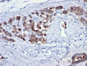 IHC staining of FFPE human gastric carcinoma with Cdc20 antibody (clone AR12). HIER: boil tissue sections in pH 9 10mM Tris with 1mM EDTA for 20 min and allow to cool before testing.
