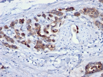 IHC staining of FFPE human gastric carcinoma with Cdc20 antibody