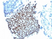 IHC testing of FFPE bladder cancer tissue with p21 antibody (clone WA-1). Required HIER: boil tissue sections in pH 9 10mM Tris with 1mM EDTA for 10-20 min followed by cooling at RT for 20 minutes.