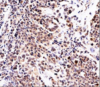 IHC testing of FFPE urinary transitional cell carcinoma with p21 antibody (clone WA-1). Required HIER: boil tissue sections in pH 9 10mM Tris with 1mM EDTA for 10-20 min followed by cooling at RT for 20 minutes.~