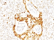 IHC staining of FFPE human colon carcinoma tissue with p287Kip1 antibody (clone SX53G8). HIER: boil tissue sections in pH8 EDTA for 20 min and allow to cool before testing.