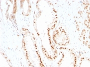 IHC staining of FFPE human prostate carcinoma tissue with p287Kip1 antibody (clone SX53G8). HIER: boil tissue sections in pH8 EDTA for 20 min and allow to cool before testing.
