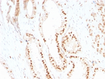 IHC staining of FFPE human prostate carcinoma tissue with p287Kip1 antibody (clone SX53G8). HIER: boil tissue sections in pH8 EDTA for 20 min and allow to cool before testing.~