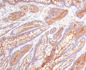 IHC testing of FFPE human colon carcinoma stained with CEA antibody (COL-1).