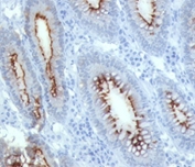 IHC with CEA antibody C66/261 colon carcinoma