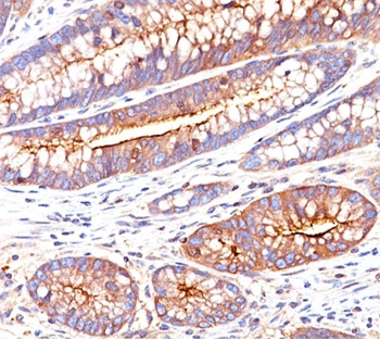 IHC testing of human colon carcinoma stained with CEA antibody (C66/261).~