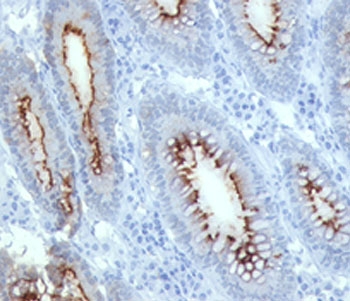 IHC testing of human colon carcinoma stained with CEA antibody (C66/261).