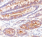 CEA antibody C66/261 immunohistochemistry1 colon carcinoma