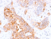 IHC testing of FFPE human colon carcinoma stained with CEA antibody (clone CEA31).