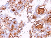 IHC testing of FFPE human colon carcinoma stained with CEA antibody (clone CEA31).