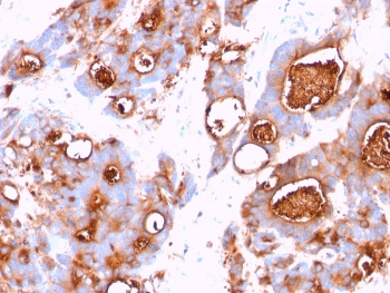 IHC testing of FFPE human colon carcinoma stained with CEA antibody (clone CEA31).