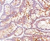 IHC testing of FFPE human colon carcinoma stained with CEA antibody (clone CEA31).