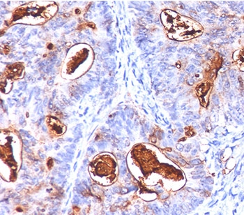 IHC testing of human colon carcinoma stained with CEA antibody cocktail (COL-1 + CEA31 + C66/261).