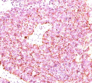 IHC testing of human small cell lung carcinoma stained with chromogranin A antibody cocktail (clones LK2H10 + PHE5 + CGA414).~