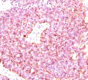 IHC testing of human small cell lung carcinoma stained with chromogranin A antibody cocktail (clones LK2H10 + PHE5 + CGA414).