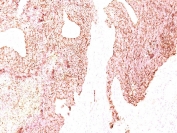 IHC testing of human small cell lung carcinoma stained with Chromogranin A antibody. HIER: boil tissue sections in pH6, 10mM citrate buffer, for 20 min and allow to cool before testing.