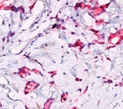 Formalin/paraffin breast lobular carcinoma stained with beta-Catenin antibody. Note cytoplasmic staining in lobular carcinoma.