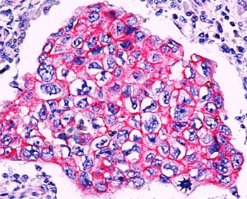 Formalin/paraffin breast ductal carcinoma stained with beta-Catenin antibody. Note membrane staining in ductal carcinoma.~