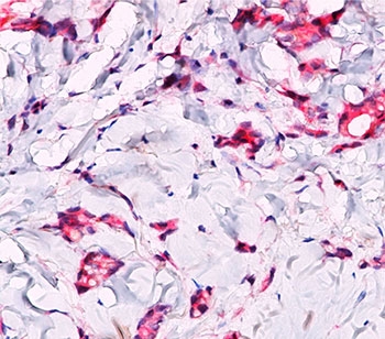 Formalin/paraffin breast lobular carcinoma stained with beta-Catenin antibody. Note cytoplasmic staining in lobula