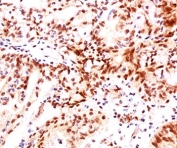 IHC testing of human ovarian cancer stained with Estrogen Receptor beta antibody (ERb455).