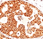 IHC testing of human breast cancer stained with Estrogen Receptor beta antibody (ERb455).