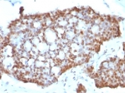 IHC testing of human gastric carcinoma stained with Estrogen Receptor beta antibody (ERb455).