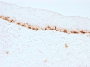 IHC testing of FFPE human skin stained with MART-1 antibody (clone M2-7C10). Note cytoplasmic staining of cells. HIER: boil tissue sections in pH 9 10mM Tris with 1mM EDTA for 10-20 min.