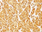 IHC testing of FFPE human melanoma stained with MART-1 antibody (clone M2-7C10). Note cytoplasmic staining of cells. HIER: boil tissue sections in pH 9 10mM Tris with 1mM EDTA for 10-20 min.
