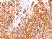 IHC testing of FFPE human melanoma stained with MART-1 antibody (clone M2-7C10). Note cytoplasmic staining of cells. HIER: boil tissue sections in pH 9 10mM Tris with 1mM EDTA for 10-20 min.