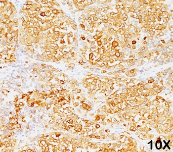 Formalin/paraffin human melanoma stained with MART-1 / Melan-A antibody (M2-9E3). Note cytoplasmic staining of cells.