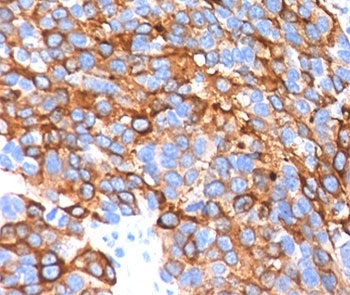 IHC testing in human melanoma stained with MART-1 antibody cocktail.~