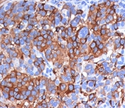 IHC testing of FFPE human melanoma stained with Melan-A antibody (clone A103).