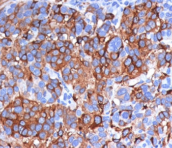 IHC testing of FFPE human melanoma stained with Melan-A antibody (clone A103).~
