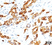 IHC testing of FFPE breast carcinoma (20X) stained with HSP27 antibody (clone G3.1).