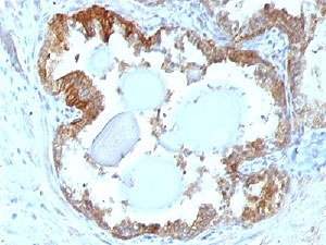 IHC testing of FFPE human prostate carcinoma and HSP27 antibody (clone G3.1.