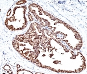 IHC testing of FFPE human breast carcinoma with HSP60 antibody (clone LK1).