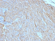 Formalin-paraffin human gastrointestinal stromal tumor (GIST) stained with CD117 antibody (clone C117/370).