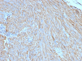 Formalin-paraffin human gastrointestinal stromal tumor (GIST) stained with CD117 antibody (clone C117/370).