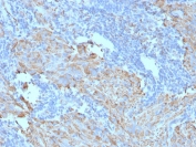 Formalin-paraffin human gastrointestinal stromal tumor (GIST) stained with CD117 antibody (clone C117/370).