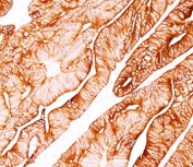 IHC testing of human colon carcinoma stained with Cytokeratin 8 antibody (clone H1).