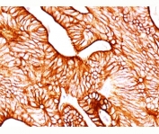 IHC testing of human colon carcinoma stained with Cytokeratin 8 antibody (TS1).