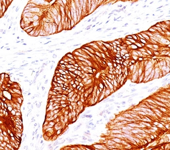 IHC testing of human colon carcinoma stained with Cytokeratin 8 antibody cocktail (H1 + TS1).~