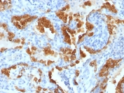 IHC testing of human lung carcinoma stained with Cytokeratin 8 antibody cocktail (H1 + TS1).