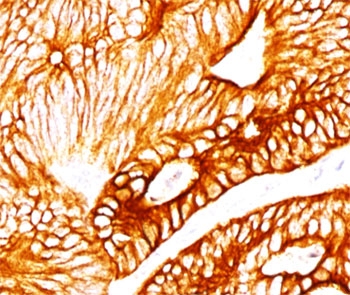 IHC testing of human colon carcinoma stained with KRT8 antibody (K8.8).