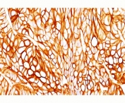 IHC testing of FFPE human colon cancer stained with Cytokeratin 18 antibody (clone DA7). 