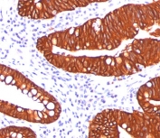 IHC testing of FFPE human colon carcinoma stained with Cytokeratin 19 antibody (clone A53-B/A2.26).