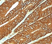 IHC testing of FFPE colon carcinoma stained with EpCAM antibody (clone VU-1D9).