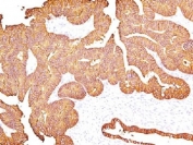 IHC testing of FFPE human colon carcinoma with EpCAM antibody (clone 323/A3).